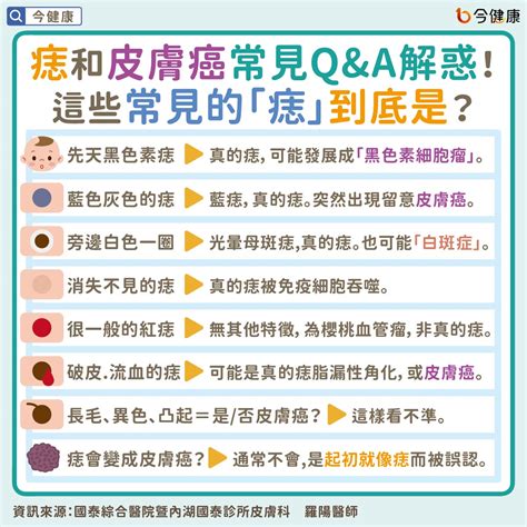 痣為什麼會凸起來|是痣or皮膚癌？醫「1張圖秒對照」 長這2部位最危險